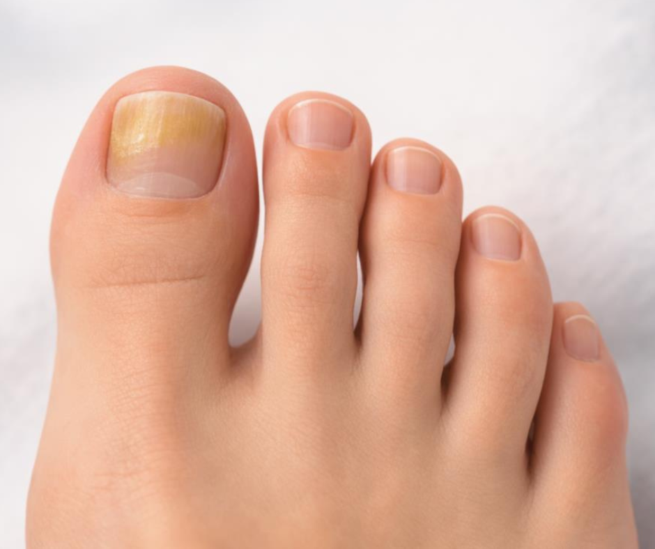 toenail fungus
